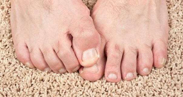 Simptomi glive za nohte