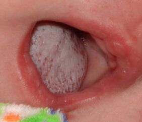 Lokalizacija bolezni z glivico