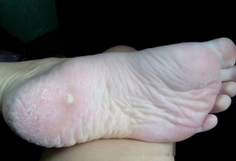 Zdravljenje glive z laserjem