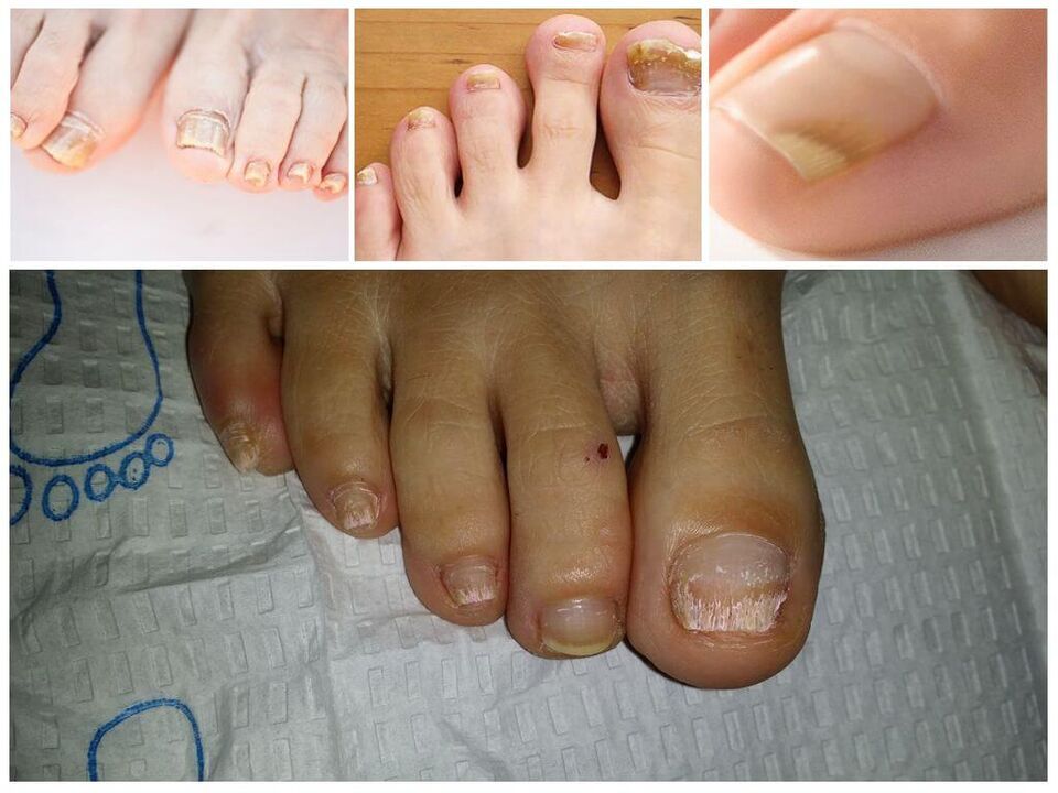 Glivične bolezni nohtnih plošč