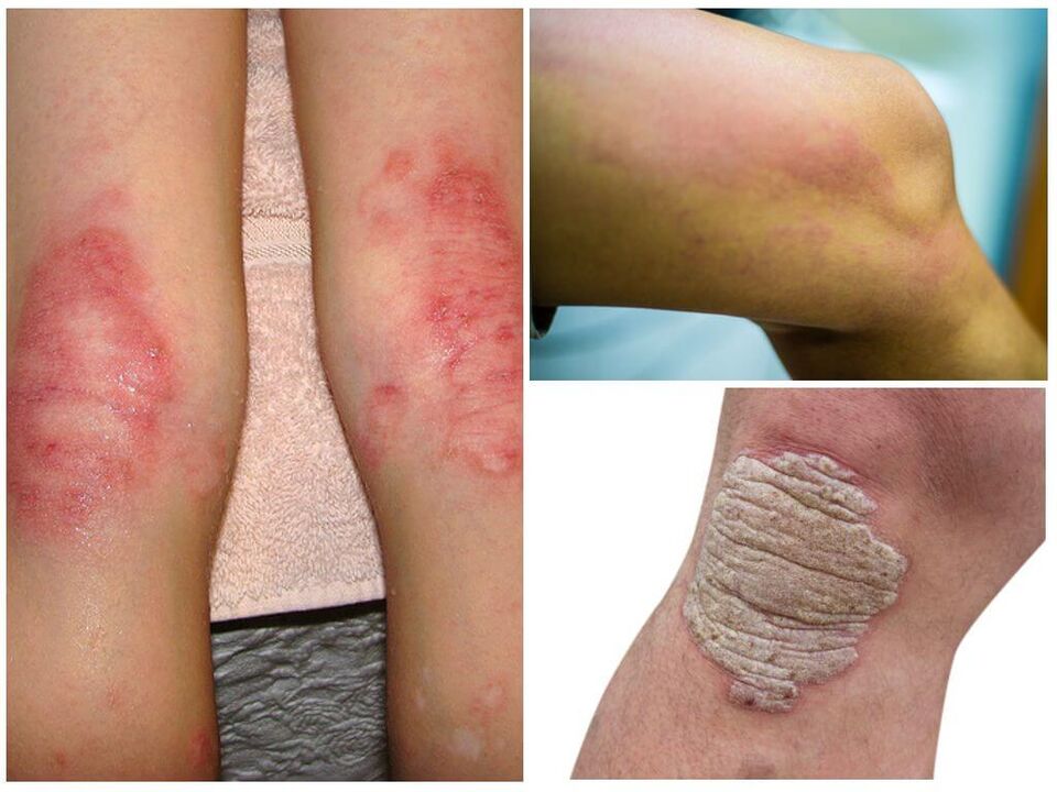 Glivične okužbe kolen