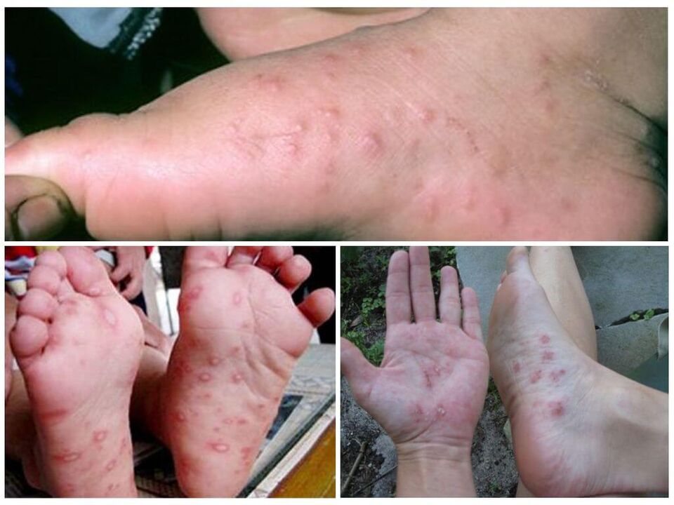 Hiperkeratotične lezije stopal