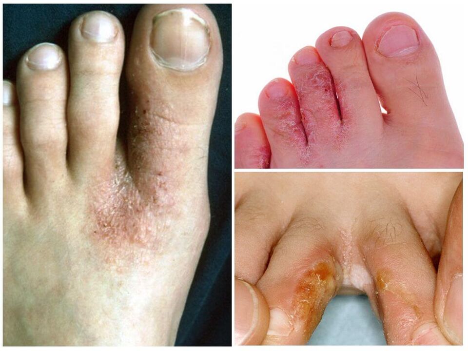 Interdigitalna mikoza