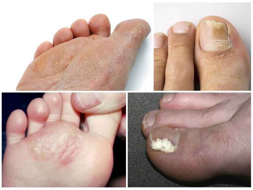 Začetna stopnja glivic na nogah