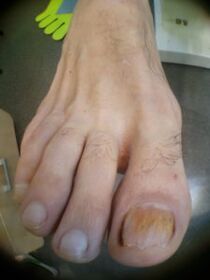 glivice na nohtih velikega prsta