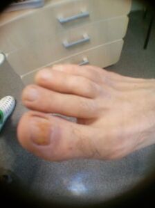 začetna stopnja glivice na nohtih velikega prsta