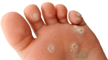 druga stopnja glivične okužbe